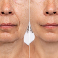 Voor en na LED gezichtsmasker